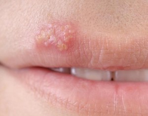 cold-sore