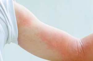 urticaria