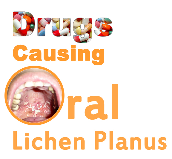 oral lichen planus cause