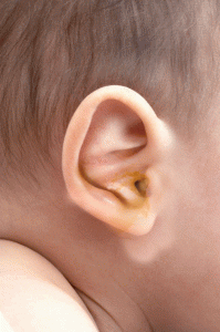 ear-infection