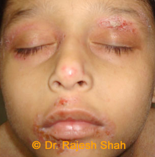 treatment for eczema