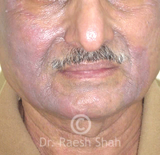 Best-treatment-for-eczema