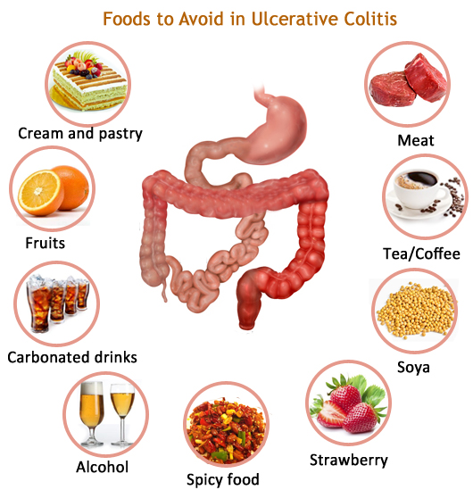 Foods to Avoid in Ulcerative Colitis