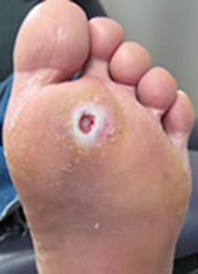 foot-ulcer