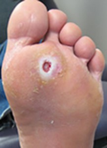 Foot Ulcer Pictures, Images & Photos | Photobucket