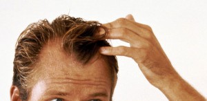 frontal-fibrosing-alopecia