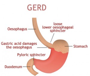 gerd_treatment