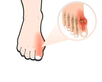 gout-and-homeopathy