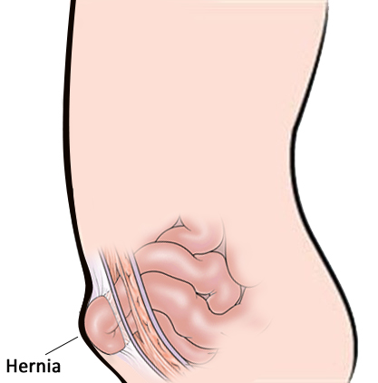 Hernia treatment with homeopathy