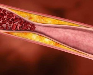 high_cholesterol