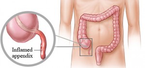 inflamed_appendix