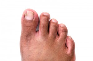 ingrown-nail