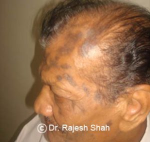 lichen-planus-affecting-scalp1