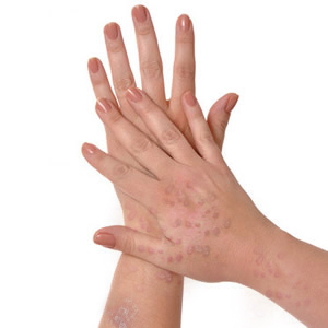 lichen planus hand