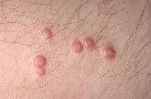 molluscum
