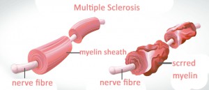 multiple-sclerosis