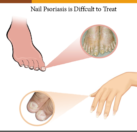 nail-psoriasis