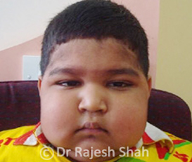 What-is-Nephrotic syndrome