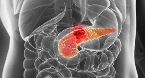 pancreatic-cancer