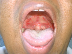 pemphigus_vulgaris_affecting_mouth