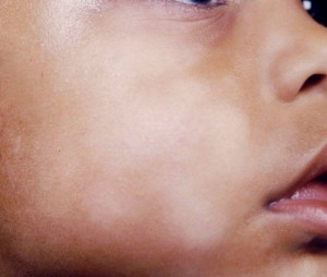pityriasis-alba
