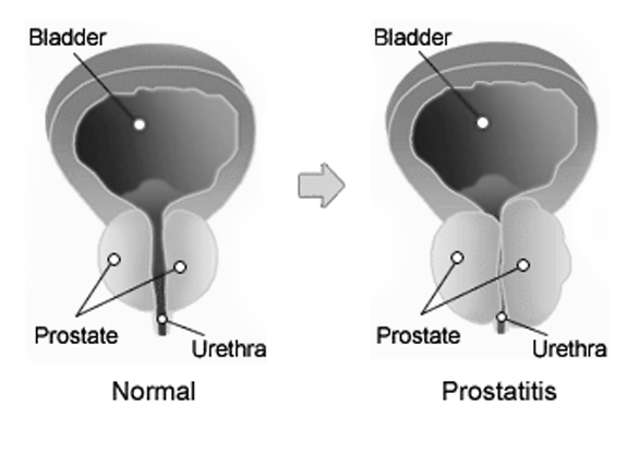 Prostatitis Treatment