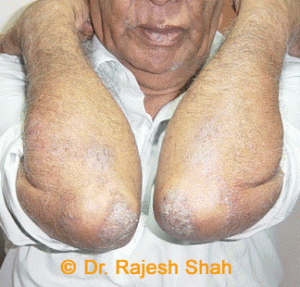 psoriasis-elbows