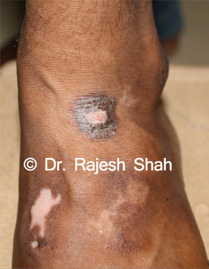 Psoriasis and vitiligo on feet