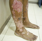 Psoriasis with vitiligo