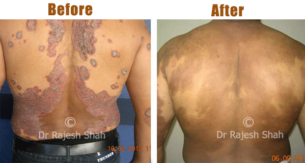 10 Foods that make Psoriasis worse