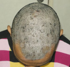 scalp psoriasis