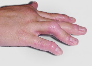psoriatic_arthritis