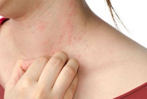 rash