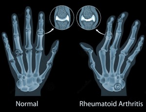 Homeopathic Treatment for Rheumatoid Arthritis