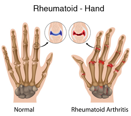 a csukló rheumatoid arthritise a lumbosacralis gerinc osteoarthritis