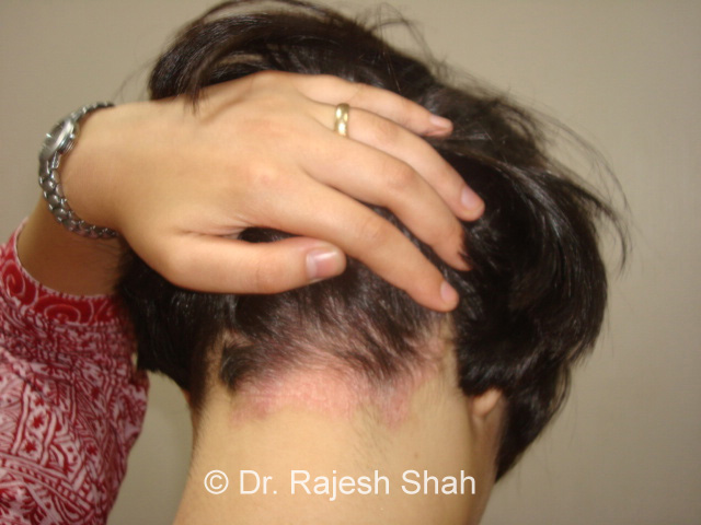 scalp psoriasis treatment at home