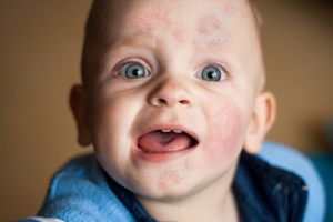 skin--infection-on-infact