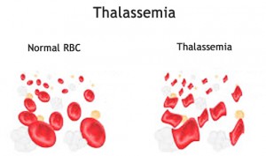 thalassemia-treatment