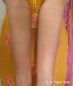 Urticaria-Cure