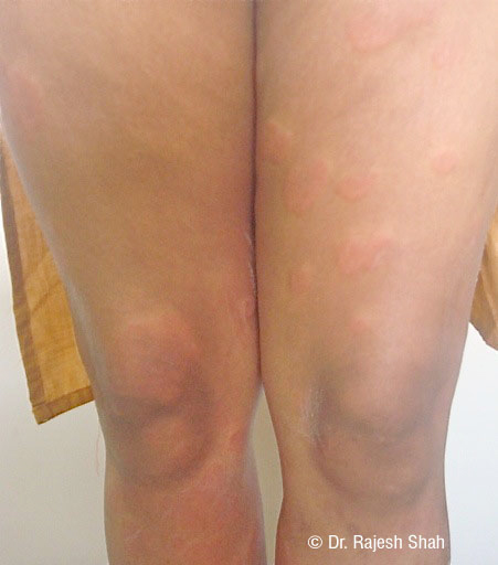 Treatment-for-Urticaria