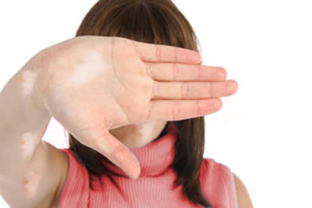 Vitiligo Treatment- A girl hand