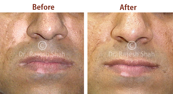 Psoriasis Before After Treatment Photos of Patients at Life Force
