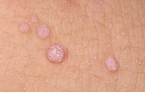 warts