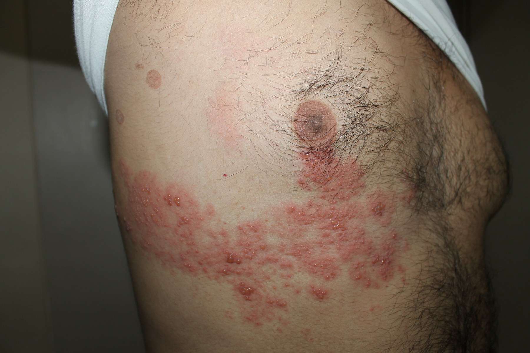Natural Treatment Shingles Symptoms Natural Treatment Shingles Symptoms