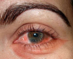 conjunctivitis