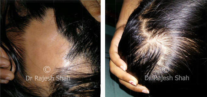 Scalp with Alopecia Areata