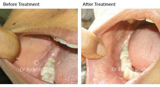 Oral lichen planus cured completely