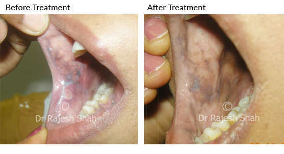 Oral lichen planus on cheeks inner side