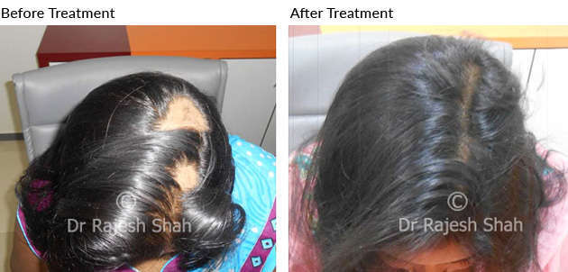 scalp cured with homeopathy