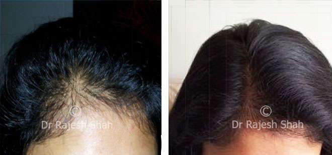 My hair fall , fissure in ano and fibroadenoma improved significantly,  thanks to Dr. Shah.